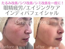 オリエンタルローザ 表参道(Oriental Rosa)/眼精疲労インディバフェイシャル