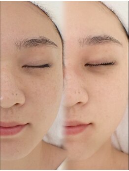 レイネ(REINE)/韓国肌管理★ララピール