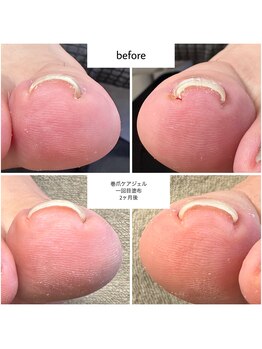 ケアプラス(care plus)/巻爪ケアジェル