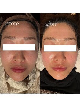 コモレビ(komorebi)/町田駅/顔脱毛/フェイスワックス