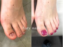 アーティネイルズ(Aaty Nails)/【深爪矯正】フット