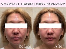 ロイボーテ(ROI Beaute)/小顔・ツヤ肌スペシャルケア♪