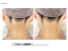 アモ(AMO)/【後ろ姿も美しく】うなじ脱毛
