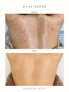 ミコル(micoru)の写真/【夏準備】見えない背中も徹底ケア！ハーブピーリングでニキビや色素沈着を改善し、魅せるツルすべ美白肌へ