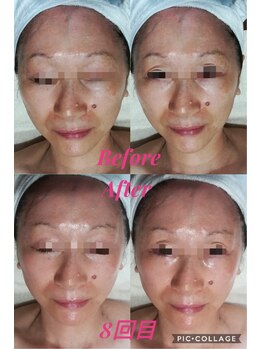 アマナプラーナ(Amana Praana)/GROTTYビフォーアフター8回目