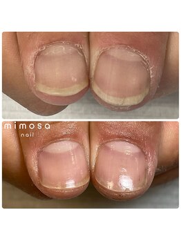 ミモザ(mimosa)/メンズネイルケア