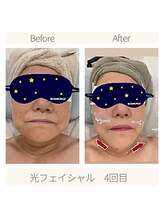 サーディン(sardine)/光フェイシャル