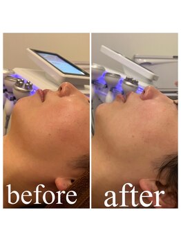 ディス イズ ミー エステティック(This is Me Aesthetic)/筋膜リフト