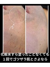 サロンド シェリー(Salon de Cherie)/男性　剥けないハーブピーリング
