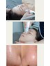 人気のハイドラフェイシャル毛穴洗浄/美容液噴射/導入EMS引き締め引き上げ