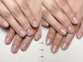 深爪矯正　長さ出し