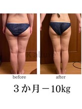 カリュール(K'allure)/太ももボコボコ　セルケア