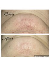 フリージア(Beauty Salon Freesia )/美肌菌活ピール1回でニキビ改善