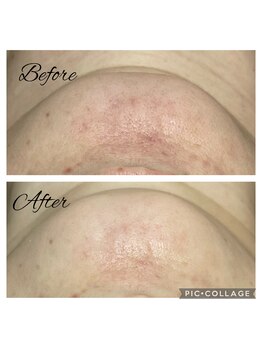 フリージア(Beauty Salon Freesia )/美肌菌活ピール1回でニキビ改善