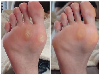 アンティ(Aunty)/当たるといたいタコ(胼胝)