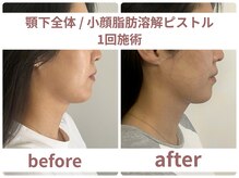 サボラミ(sabor A Mi)/顎下全体　脂肪分解ピストル