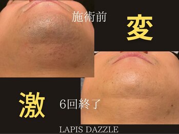 ラピスダズル(LAPIS DAZZLE)/ヒゲ脱毛☆途中経過