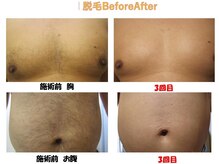 ピービー(PB)/脱毛