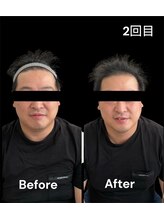 ブライトプラス(BRIGHT+)/ハイドロ毛穴洗浄+小顔ケア