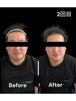 ブライトプラス(BRIGHT+)/ハイドロ毛穴洗浄+小顔ケア