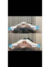 ヴィバランス(Vebalance)/巻き肩に対する矯正