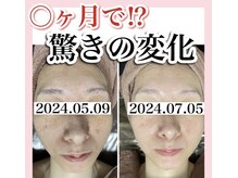 ホワイトアクア 姫路店(WHITE AQUA)/ララピール/姫路/美白