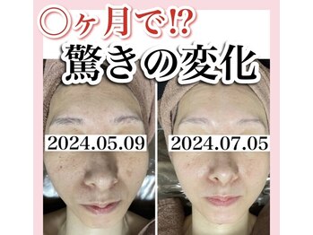 ホワイトアクア 姫路店(WHITE AQUA)/ララピール/姫路/美白