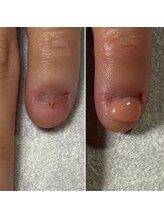 トレフル(Trefle)/深爪ほとんど爪がなくても綺麗に