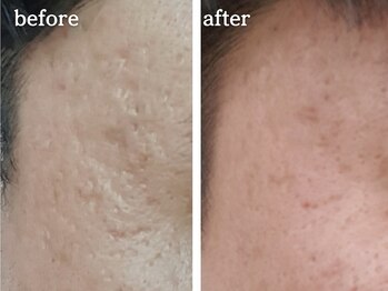 メルシア(merucia)/跡、ニキビケア、凸凹ケア