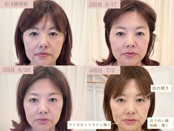 ネテマテ 表参道(netemate)/美容鍼/レモンボトル