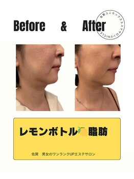 ユニクリア(Uni clear)/二重あご・ほうれい線