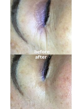 セレネ(SELENE)/目尻のシワ、乾燥、小皺