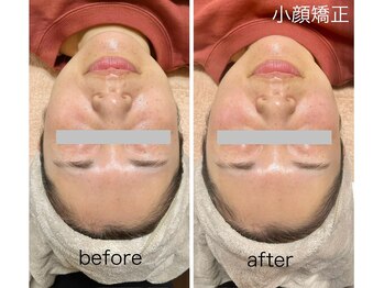 ミニン(minin)/小顔矯正