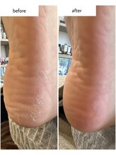 ケアプラス(care plus)/足裏角質ケア