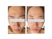 イロドリ(IRODORI)/REVIハーブピーリング