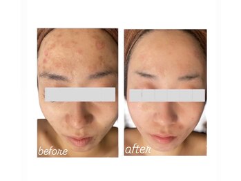 イロドリ(IRODORI)/REVIハーブピーリング