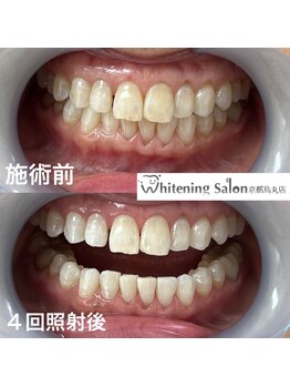 ホワイトニングサロン 京都烏丸店/ホワイトニング施術前