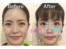 ラプリ 横浜店(Raplit)/隆鼻＋輪郭矯正40分