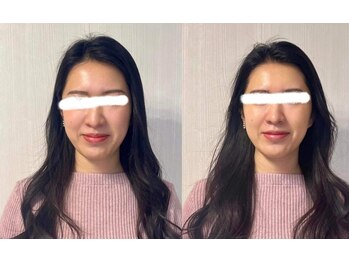 ラリマール/お客様ビフォーアフター