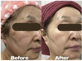 リノズ(Lino's)/【ビフォーアフター】10ヶ月