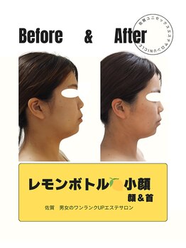 ユニクリア(Uni clear)/結果重視!レモンボトル小顔施術