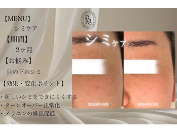 アールエーサロン 恵比寿 広尾(Ra salon)/シミケア