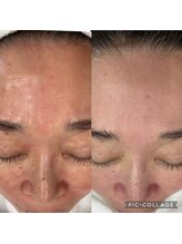 ラズ(Luz)/シミケアと雪花ピール