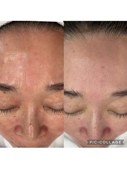 ラズ(Luz)/シミケアと雪花ピール