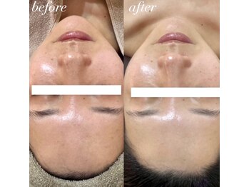 ピエル 柏店(PIEL)の写真/【人気No,1セットメニュー】古い角質・角栓をすっきりオフしてから“肌悩み別ピーリング”で、狙い撃ち！
