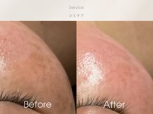 フェイシャルサロン ベルダ(BELDA)/【シミケア】