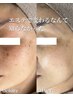 【最近おシミが増えたと感じる方】1番人気◇透明感集中導入ケア16500→12600