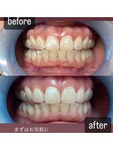 アオ(AO)/セルフホワイトニング