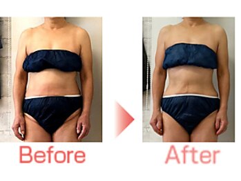 ピーキュア/3カ月のビフォーアフター