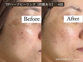 ジュパール(je pars)/TIPハーブピーリング